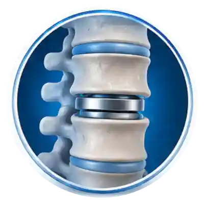 Artificial Disc Replacement