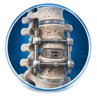 Dual Cage Fusion Surgery