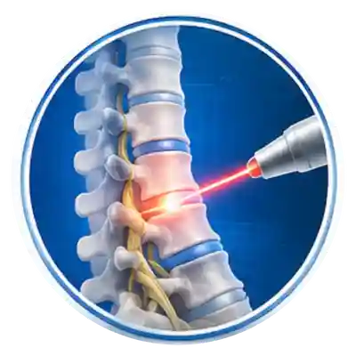 Laser Spine Surgery